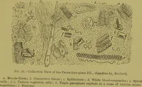 An illustration from Clinical diagnosis : the bacteriological, chemical, and microscopical evidence of disease / By Dr. Rudolf v. Jaksch, ... Translated from the third German edition and enlarged by James Cagney, ... With numerous illustrations (partly in colours). (1893)