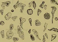An illustration from Clinical diagnosis : the bacteriological, chemical, and microscopical evidence of disease / By Dr. Rudolf v. Jaksch, ... Translated from the third German edition and enlarged by James Cagney, ... With numerous illustrations (partly in colours). (1893)