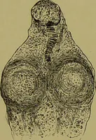 An illustration from Clinical diagnosis : the bacteriological, chemical, and microscopical evidence of disease / By Dr. Rudolf v. Jaksch, ... Translated from the third German edition and enlarged by James Cagney, ... With numerous illustrations (partly in colours). (1893)