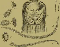 An illustration from Clinical diagnosis : the bacteriological, chemical, and microscopical evidence of disease / By Dr. Rudolf v. Jaksch, ... Translated from the third German edition and enlarged by James Cagney, ... With numerous illustrations (partly in colours). (1893)