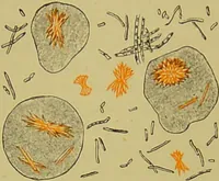 Picture 31 of 61 from Clinical diagnosis : the bacteriological, chemical, and microscopical evidence of disease / By Dr. Rudolf v. Jaksch, ... Translated from the third German edition and enlarged by James Cagney, ... With numerous illustrations (partly in colours). (1893), leaf 224