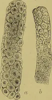 An illustration from Clinical diagnosis : the bacteriological, chemical, and microscopical evidence of disease / By Dr. Rudolf v. Jaksch, ... Translated from the third German edition and enlarged by James Cagney, ... With numerous illustrations (partly in colours). (1893)