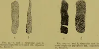 An illustration from Clinical diagnosis : the bacteriological, chemical, and microscopical evidence of disease / By Dr. Rudolf v. Jaksch, ... Translated from the third German edition and enlarged by James Cagney, ... With numerous illustrations (partly in colours). (1893)