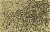An illustration from Clinical diagnosis : the bacteriological, chemical, and microscopical evidence of disease / By Dr. Rudolf v. Jaksch, ... Translated from the third German edition and enlarged by James Cagney, ... With numerous illustrations (partly in colours). (1893)