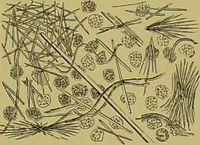 An illustration from Clinical diagnosis : the bacteriological, chemical, and microscopical evidence of disease / By Dr. Rudolf v. Jaksch, ... Translated from the third German edition and enlarged by James Cagney, ... With numerous illustrations (partly in colours). (1893)