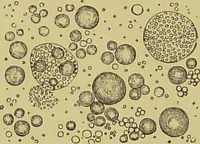 An illustration from Clinical diagnosis : the bacteriological, chemical, and microscopical evidence of disease / By Dr. Rudolf v. Jaksch, ... Translated from the third German edition and enlarged by James Cagney, ... With numerous illustrations (partly in colours). (1893)