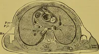 An illustration from Clinical diagnosis : the bacteriological, chemical, and microscopical evidence of disease / By Dr. Rudolf v. Jaksch, ... Translated from the third German edition and enlarged by James Cagney, ... With numerous illustrations (partly in colours). (1893)