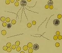 Picture 5 of 61 from Clinical diagnosis : the bacteriological, chemical, and microscopical evidence of disease / By Dr. Rudolf v. Jaksch, ... Translated from the third German edition and enlarged by James Cagney, ... With numerous illustrations (partly in colours). (1893), leaf 72