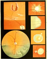An illustration from Atlas of ophthalmoscopy : Representing the normal and pathological conditions of the fundus oculi as seen with the ophthalmoscope. Composed of 12 chromolithographic plates, containing 59 figures, drawn from nature and accompanied by an explanatory text / by Dr. R. Liebreich, the text translated by H. Rosborough Swanzy. (1870)