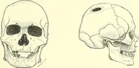 An illustration from Des déformations artificielles du crâne en général de celles de deux crânes macrocéphales trouvés en Hongrie et d'un crâne provenant des temps barbares du meme pays / par Joseph de Lenhossék. (1878)
