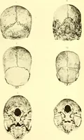 An illustration from Des déformations artificielles du crâne en général de celles de deux crânes macrocéphales trouvés en Hongrie et d'un crâne provenant des temps barbares du meme pays / par Joseph de Lenhossék. (1878)