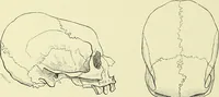 An illustration from Des déformations artificielles du crâne en général de celles de deux crânes macrocéphales trouvés en Hongrie et d'un crâne provenant des temps barbares du meme pays / par Joseph de Lenhossék. (1878)