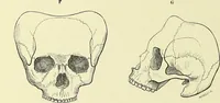 An illustration from Des déformations artificielles du crâne en général de celles de deux crânes macrocéphales trouvés en Hongrie et d'un crâne provenant des temps barbares du meme pays / par Joseph de Lenhossék. (1878)