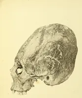 An illustration from Des déformations artificielles du crâne en général de celles de deux crânes macrocéphales trouvés en Hongrie et d'un crâne provenant des temps barbares du meme pays / par Joseph de Lenhossék. (1878)