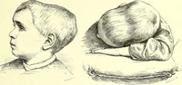 An illustration from Des déformations artificielles du crâne en général de celles de deux crânes macrocéphales trouvés en Hongrie et d'un crâne provenant des temps barbares du meme pays / par Joseph de Lenhossék. (1878)