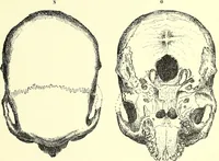 An illustration from Des déformations artificielles du crâne en général de celles de deux crânes macrocéphales trouvés en Hongrie et d'un crâne provenant des temps barbares du meme pays / par Joseph de Lenhossék. (1878)