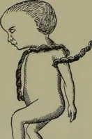 Picture 4 of 111 from Anomalies and curiosities of medicine : being an encyclopedic collection of rare and extraordinary cases, and of the most striking instances of abnormality in all branches of medicine and surgery, derived from an exhaustive research of medical literature from its origin to the present day / abstracted, classified, annotated, and indexed, by George M. Gould and Walter L. Pyle ; with 295 illustrations in the text, and 12 half-tone and colored plates. (1897), leaf 104