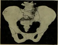 Picture 7 of 111 from Anomalies and curiosities of medicine : being an encyclopedic collection of rare and extraordinary cases, and of the most striking instances of abnormality in all branches of medicine and surgery, derived from an exhaustive research of medical literature from its origin to the present day / abstracted, classified, annotated, and indexed, by George M. Gould and Walter L. Pyle ; with 295 illustrations in the text, and 12 half-tone and colored plates. (1897), leaf 146