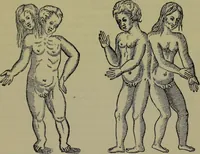 An illustration from Anomalies and curiosities of medicine : being an encyclopedic collection of rare and extraordinary cases, and of the most striking instances of abnormality in all branches of medicine and surgery, derived from an exhaustive research of medical literature from its origin to the present day / abstracted, classified, annotated, and indexed, by George M. Gould and Walter L. Pyle ; with 295 illustrations in the text, and 12 half-tone and colored plates. (1897)