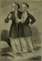 An illustration from Anomalies and curiosities of medicine : being an encyclopedic collection of rare and extraordinary cases, and of the most striking instances of abnormality in all branches of medicine and surgery, derived from an exhaustive research of medical literature from its origin to the present day / abstracted, classified, annotated, and indexed, by George M. Gould and Walter L. Pyle ; with 295 illustrations in the text, and 12 half-tone and colored plates. (1897)