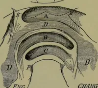 Picture 17 of 111 from Anomalies and curiosities of medicine : being an encyclopedic collection of rare and extraordinary cases, and of the most striking instances of abnormality in all branches of medicine and surgery, derived from an exhaustive research of medical literature from its origin to the present day / abstracted, classified, annotated, and indexed, by George M. Gould and Walter L. Pyle ; with 295 illustrations in the text, and 12 half-tone and colored plates. (1897), leaf 177