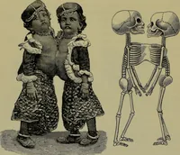 Picture 18 of 111 from Anomalies and curiosities of medicine : being an encyclopedic collection of rare and extraordinary cases, and of the most striking instances of abnormality in all branches of medicine and surgery, derived from an exhaustive research of medical literature from its origin to the present day / abstracted, classified, annotated, and indexed, by George M. Gould and Walter L. Pyle ; with 295 illustrations in the text, and 12 half-tone and colored plates. (1897), leaf 178