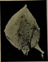 Picture 30 of 111 from Anomalies and curiosities of medicine : being an encyclopedic collection of rare and extraordinary cases, and of the most striking instances of abnormality in all branches of medicine and surgery, derived from an exhaustive research of medical literature from its origin to the present day / abstracted, classified, annotated, and indexed, by George M. Gould and Walter L. Pyle ; with 295 illustrations in the text, and 12 half-tone and colored plates. (1897), leaf 211