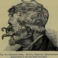 Picture 36 of 111 from Anomalies and curiosities of medicine : being an encyclopedic collection of rare and extraordinary cases, and of the most striking instances of abnormality in all branches of medicine and surgery, derived from an exhaustive research of medical literature from its origin to the present day / abstracted, classified, annotated, and indexed, by George M. Gould and Walter L. Pyle ; with 295 illustrations in the text, and 12 half-tone and colored plates. (1897), leaf 236