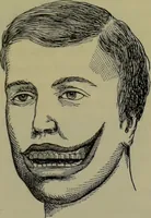 An illustration from Anomalies and curiosities of medicine : being an encyclopedic collection of rare and extraordinary cases, and of the most striking instances of abnormality in all branches of medicine and surgery, derived from an exhaustive research of medical literature from its origin to the present day / abstracted, classified, annotated, and indexed, by George M. Gould and Walter L. Pyle ; with 295 illustrations in the text, and 12 half-tone and colored plates. (1897)