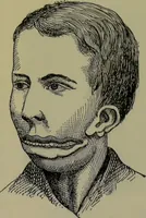 An illustration from Anomalies and curiosities of medicine : being an encyclopedic collection of rare and extraordinary cases, and of the most striking instances of abnormality in all branches of medicine and surgery, derived from an exhaustive research of medical literature from its origin to the present day / abstracted, classified, annotated, and indexed, by George M. Gould and Walter L. Pyle ; with 295 illustrations in the text, and 12 half-tone and colored plates. (1897)