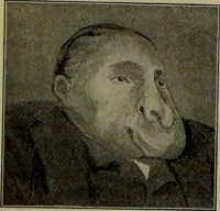An illustration from Anomalies and curiosities of medicine : being an encyclopedic collection of rare and extraordinary cases, and of the most striking instances of abnormality in all branches of medicine and surgery, derived from an exhaustive research of medical literature from its origin to the present day / abstracted, classified, annotated, and indexed, by George M. Gould and Walter L. Pyle ; with 295 illustrations in the text, and 12 half-tone and colored plates. (1897)