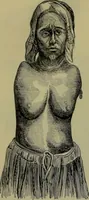An illustration from Anomalies and curiosities of medicine : being an encyclopedic collection of rare and extraordinary cases, and of the most striking instances of abnormality in all branches of medicine and surgery, derived from an exhaustive research of medical literature from its origin to the present day / abstracted, classified, annotated, and indexed, by George M. Gould and Walter L. Pyle ; with 295 illustrations in the text, and 12 half-tone and colored plates. (1897)