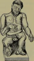 Picture 54 of 111 from Anomalies and curiosities of medicine : being an encyclopedic collection of rare and extraordinary cases, and of the most striking instances of abnormality in all branches of medicine and surgery, derived from an exhaustive research of medical literature from its origin to the present day / abstracted, classified, annotated, and indexed, by George M. Gould and Walter L. Pyle ; with 295 illustrations in the text, and 12 half-tone and colored plates. (1897), leaf 276