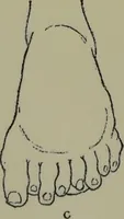 An illustration from Anomalies and curiosities of medicine : being an encyclopedic collection of rare and extraordinary cases, and of the most striking instances of abnormality in all branches of medicine and surgery, derived from an exhaustive research of medical literature from its origin to the present day / abstracted, classified, annotated, and indexed, by George M. Gould and Walter L. Pyle ; with 295 illustrations in the text, and 12 half-tone and colored plates. (1897)
