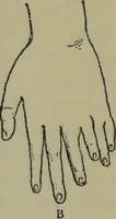 An illustration from Anomalies and curiosities of medicine : being an encyclopedic collection of rare and extraordinary cases, and of the most striking instances of abnormality in all branches of medicine and surgery, derived from an exhaustive research of medical literature from its origin to the present day / abstracted, classified, annotated, and indexed, by George M. Gould and Walter L. Pyle ; with 295 illustrations in the text, and 12 half-tone and colored plates. (1897)
