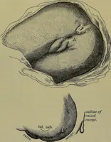 Picture 58 of 111 from Anomalies and curiosities of medicine : being an encyclopedic collection of rare and extraordinary cases, and of the most striking instances of abnormality in all branches of medicine and surgery, derived from an exhaustive research of medical literature from its origin to the present day / abstracted, classified, annotated, and indexed, by George M. Gould and Walter L. Pyle ; with 295 illustrations in the text, and 12 half-tone and colored plates. (1897), leaf 290