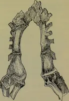 An illustration from Anomalies and curiosities of medicine : being an encyclopedic collection of rare and extraordinary cases, and of the most striking instances of abnormality in all branches of medicine and surgery, derived from an exhaustive research of medical literature from its origin to the present day / abstracted, classified, annotated, and indexed, by George M. Gould and Walter L. Pyle ; with 295 illustrations in the text, and 12 half-tone and colored plates. (1897)