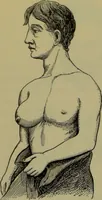 An illustration from Anomalies and curiosities of medicine : being an encyclopedic collection of rare and extraordinary cases, and of the most striking instances of abnormality in all branches of medicine and surgery, derived from an exhaustive research of medical literature from its origin to the present day / abstracted, classified, annotated, and indexed, by George M. Gould and Walter L. Pyle ; with 295 illustrations in the text, and 12 half-tone and colored plates. (1897)