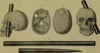 Picture 77 of 111 from Anomalies and curiosities of medicine : being an encyclopedic collection of rare and extraordinary cases, and of the most striking instances of abnormality in all branches of medicine and surgery, derived from an exhaustive research of medical literature from its origin to the present day / abstracted, classified, annotated, and indexed, by George M. Gould and Walter L. Pyle ; with 295 illustrations in the text, and 12 half-tone and colored plates. (1897), leaf 565