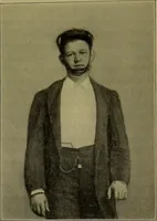An illustration from Anomalies and curiosities of medicine : being an encyclopedic collection of rare and extraordinary cases, and of the most striking instances of abnormality in all branches of medicine and surgery, derived from an exhaustive research of medical literature from its origin to the present day / abstracted, classified, annotated, and indexed, by George M. Gould and Walter L. Pyle ; with 295 illustrations in the text, and 12 half-tone and colored plates. (1897)