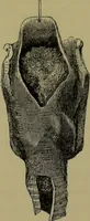 An illustration from Anomalies and curiosities of medicine : being an encyclopedic collection of rare and extraordinary cases, and of the most striking instances of abnormality in all branches of medicine and surgery, derived from an exhaustive research of medical literature from its origin to the present day / abstracted, classified, annotated, and indexed, by George M. Gould and Walter L. Pyle ; with 295 illustrations in the text, and 12 half-tone and colored plates. (1897)