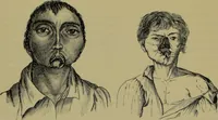 An illustration from Anomalies and curiosities of medicine : being an encyclopedic collection of rare and extraordinary cases, and of the most striking instances of abnormality in all branches of medicine and surgery, derived from an exhaustive research of medical literature from its origin to the present day / abstracted, classified, annotated, and indexed, by George M. Gould and Walter L. Pyle ; with 295 illustrations in the text, and 12 half-tone and colored plates. (1897)