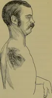 An illustration from Anomalies and curiosities of medicine : being an encyclopedic collection of rare and extraordinary cases, and of the most striking instances of abnormality in all branches of medicine and surgery, derived from an exhaustive research of medical literature from its origin to the present day / abstracted, classified, annotated, and indexed, by George M. Gould and Walter L. Pyle ; with 295 illustrations in the text, and 12 half-tone and colored plates. (1897)
