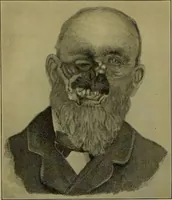 Picture 99 of 111 from Anomalies and curiosities of medicine : being an encyclopedic collection of rare and extraordinary cases, and of the most striking instances of abnormality in all branches of medicine and surgery, derived from an exhaustive research of medical literature from its origin to the present day / abstracted, classified, annotated, and indexed, by George M. Gould and Walter L. Pyle ; with 295 illustrations in the text, and 12 half-tone and colored plates. (1897), leaf 784
