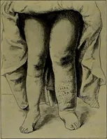 An illustration from Anomalies and curiosities of medicine : being an encyclopedic collection of rare and extraordinary cases, and of the most striking instances of abnormality in all branches of medicine and surgery, derived from an exhaustive research of medical literature from its origin to the present day / abstracted, classified, annotated, and indexed, by George M. Gould and Walter L. Pyle ; with 295 illustrations in the text, and 12 half-tone and colored plates. (1897)