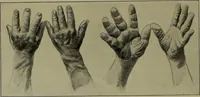 Picture 107 of 111 from Anomalies and curiosities of medicine : being an encyclopedic collection of rare and extraordinary cases, and of the most striking instances of abnormality in all branches of medicine and surgery, derived from an exhaustive research of medical literature from its origin to the present day / abstracted, classified, annotated, and indexed, by George M. Gould and Walter L. Pyle ; with 295 illustrations in the text, and 12 half-tone and colored plates. (1897), leaf 816