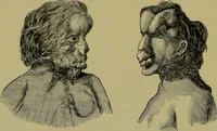 An illustration from Anomalies and curiosities of medicine : being an encyclopedic collection of rare and extraordinary cases, and of the most striking instances of abnormality in all branches of medicine and surgery, derived from an exhaustive research of medical literature from its origin to the present day / abstracted, classified, annotated, and indexed, by George M. Gould and Walter L. Pyle ; with 295 illustrations in the text, and 12 half-tone and colored plates. (1897)