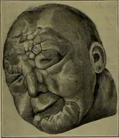 An illustration from Anomalies and curiosities of medicine : being an encyclopedic collection of rare and extraordinary cases, and of the most striking instances of abnormality in all branches of medicine and surgery, derived from an exhaustive research of medical literature from its origin to the present day / abstracted, classified, annotated, and indexed, by George M. Gould and Walter L. Pyle ; with 295 illustrations in the text, and 12 half-tone and colored plates. (1897)