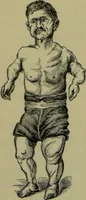 An illustration from Anomalies and curiosities of medicine : being an encyclopedic collection of rare and extraordinary cases, and of the most striking instances of abnormality in all branches of medicine and surgery, derived from an exhaustive research of medical literature from its origin to the present day / abstracted, classified, annotated, and indexed, by George M. Gould and Walter L. Pyle ; with 295 illustrations in the text, and 12 half-tone and colored plates. (1897)