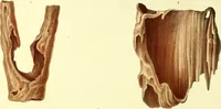 An illustration from Graphic illustrations of abortion and the diseases of menstruation. Consisting of twelve plates from drawings engraved on stone, and coloured by Mr. J. Perry, and two copperplates from the Philosophical transactions, coloured by the same artist. The whole representing forty-five specimens of aborted ova and adventitious productions of the uterus, with preliminary observations, explanations of the figures, and remarks, anatomical physiological / by A.B. Granville. (1834)